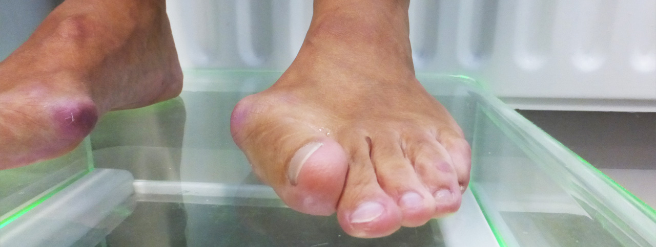 Een bult bij de grote teen (hallux valgus) Een bult bij de grote teen (hallux valgus)